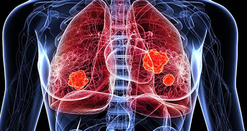 Lung Cancer Specialist in Sonipat